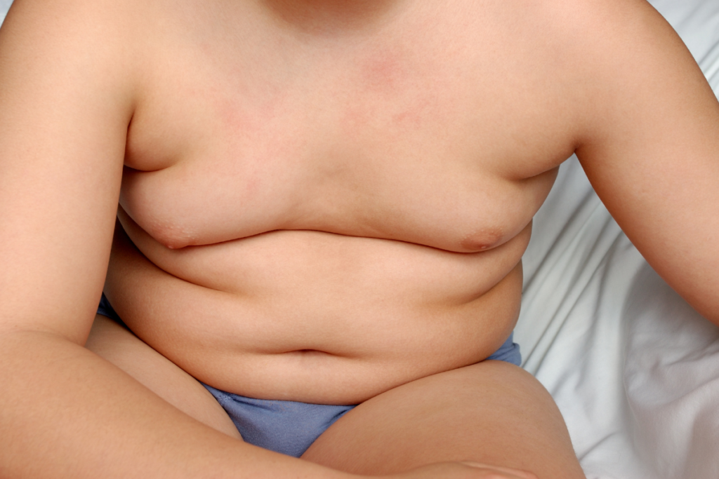 Obesidade pode atingir metade das crianças e adolescentes até 2035 2 obesidade