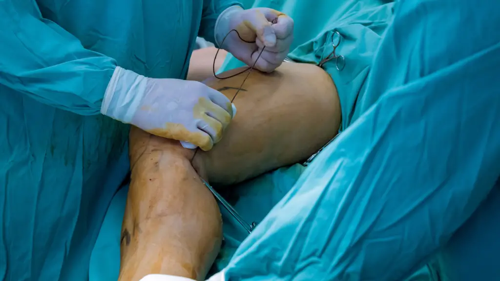 Cepon realiza cirurgia inédita para tratar câncer ósseo e preserva perna de paciente com osteossarcoma 3 Pela primeira vez, o Cepon, em Florianópolis, realizou uma cirurgia de reconstrução de membro inferior para tratar osteossarcoma, permitindo a preservação da perna do paciente. Avanço é marco no tratamento oncológico pelo SUS em Santa Catarina.