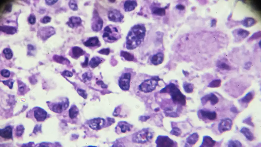 Cepon realiza cirurgia inédita para tratar câncer ósseo e preserva perna de paciente com osteossarcoma 2 Pela primeira vez, o Cepon, em Florianópolis, realizou uma cirurgia de reconstrução de membro inferior para tratar osteossarcoma, permitindo a preservação da perna do paciente. Avanço é marco no tratamento oncológico pelo SUS em Santa Catarina.