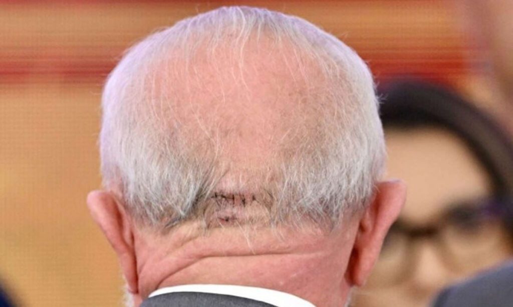 Lula é submetido a cirurgia de emergência após hemorragia cerebral; ele segue na UTI 4 Segundo o boletim médico, a cirurgia aconteceu sem intercorrências, e o presidente passa bem. Lula segue sendo monitorado na UTI