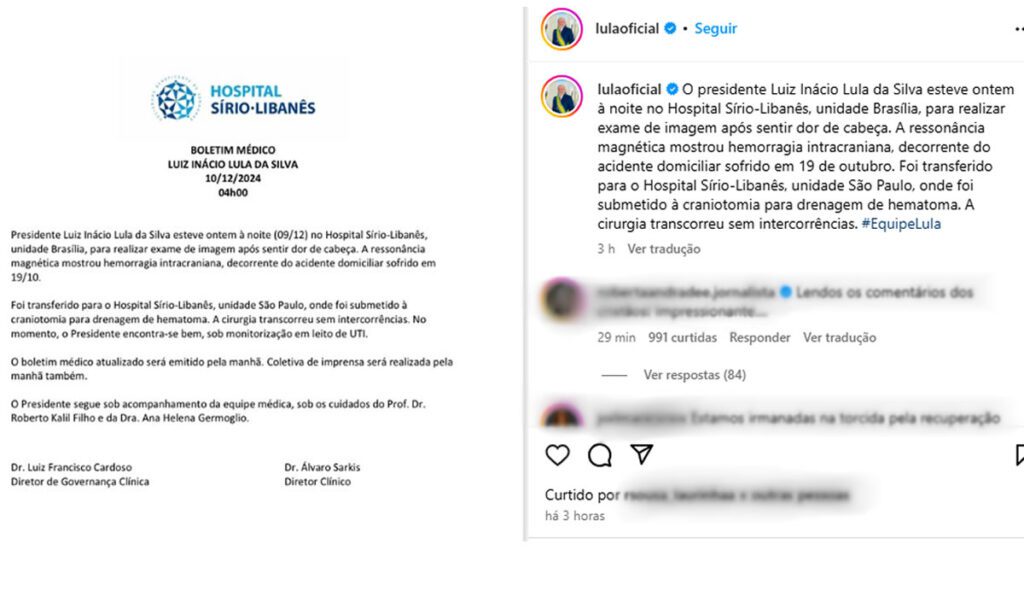 Lula é submetido a cirurgia de emergência após hemorragia cerebral; ele segue na UTI 3 jnfrymgy