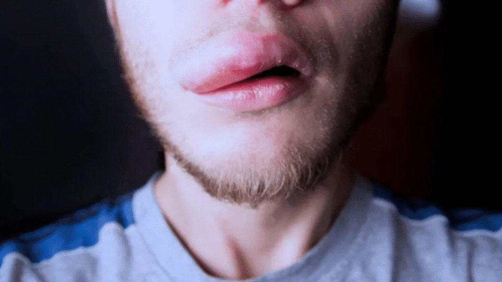 Anvisa mantém investigação sobre o Colgate Clean Mint após mais de 1.200 casos de reações adversas 2 Mais de 1.200 pessoas relataram reações ao creme dental Colgate Total Clean Mint. Produto segue suspenso enquanto a Anvisa investiga as causas