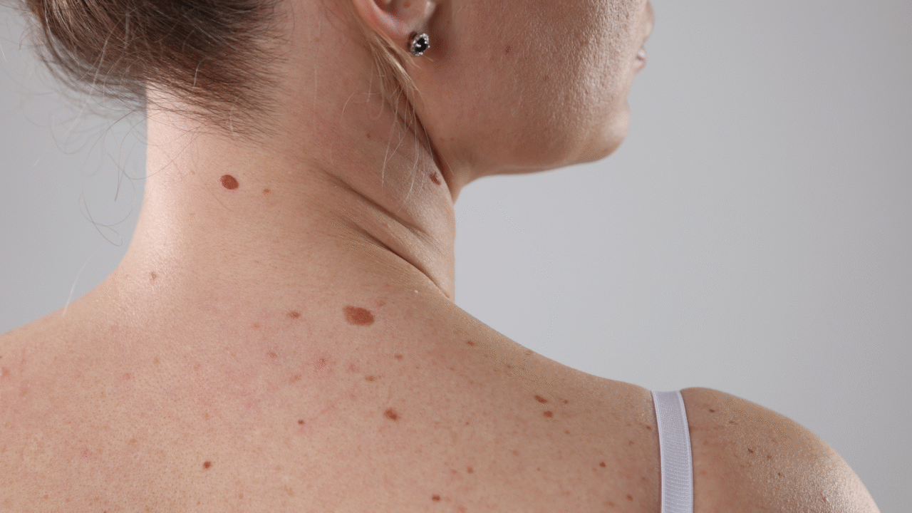O que são as pintinhas que temos no corpo: significados, origens e curiosidades sobre essas marcas