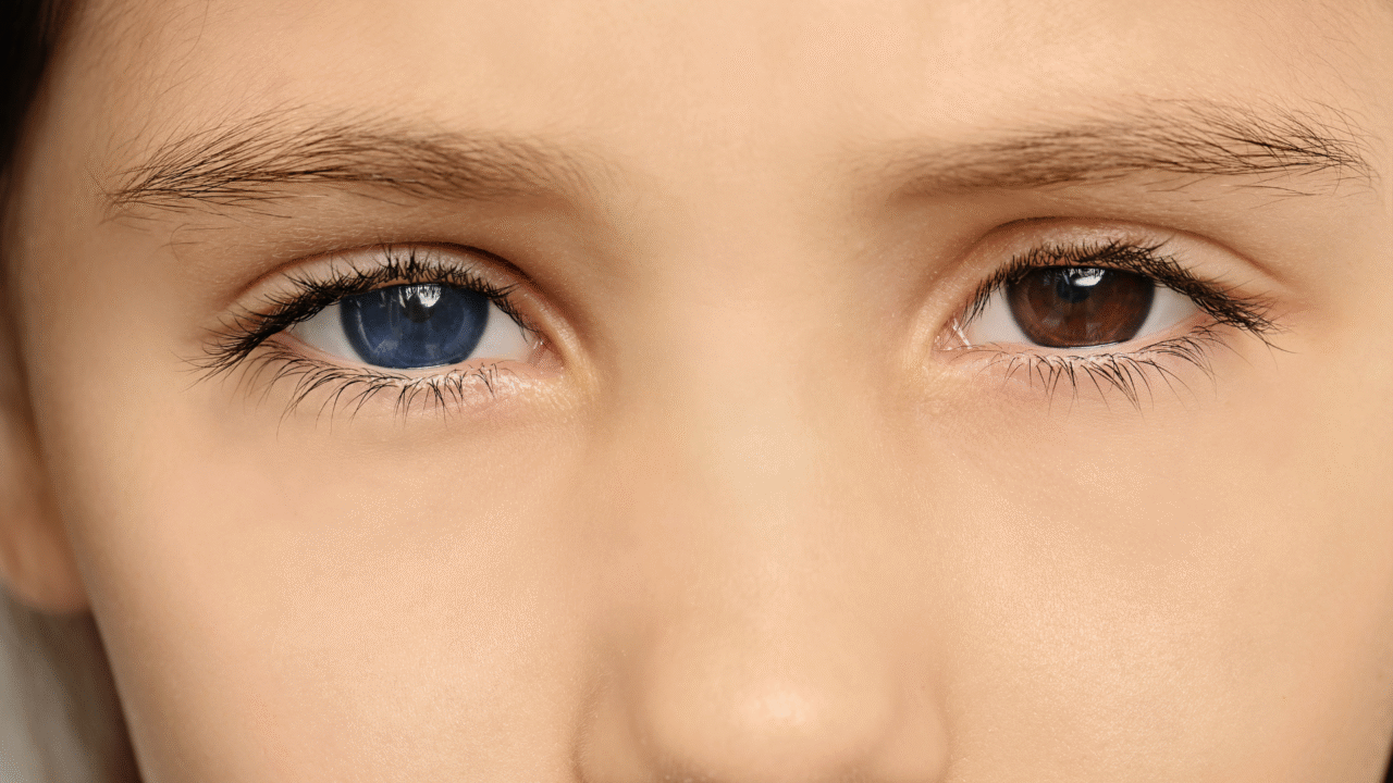 Por que algumas pessoas têm olhos de cores diferentes? O fascinante mistério da heterocromia
