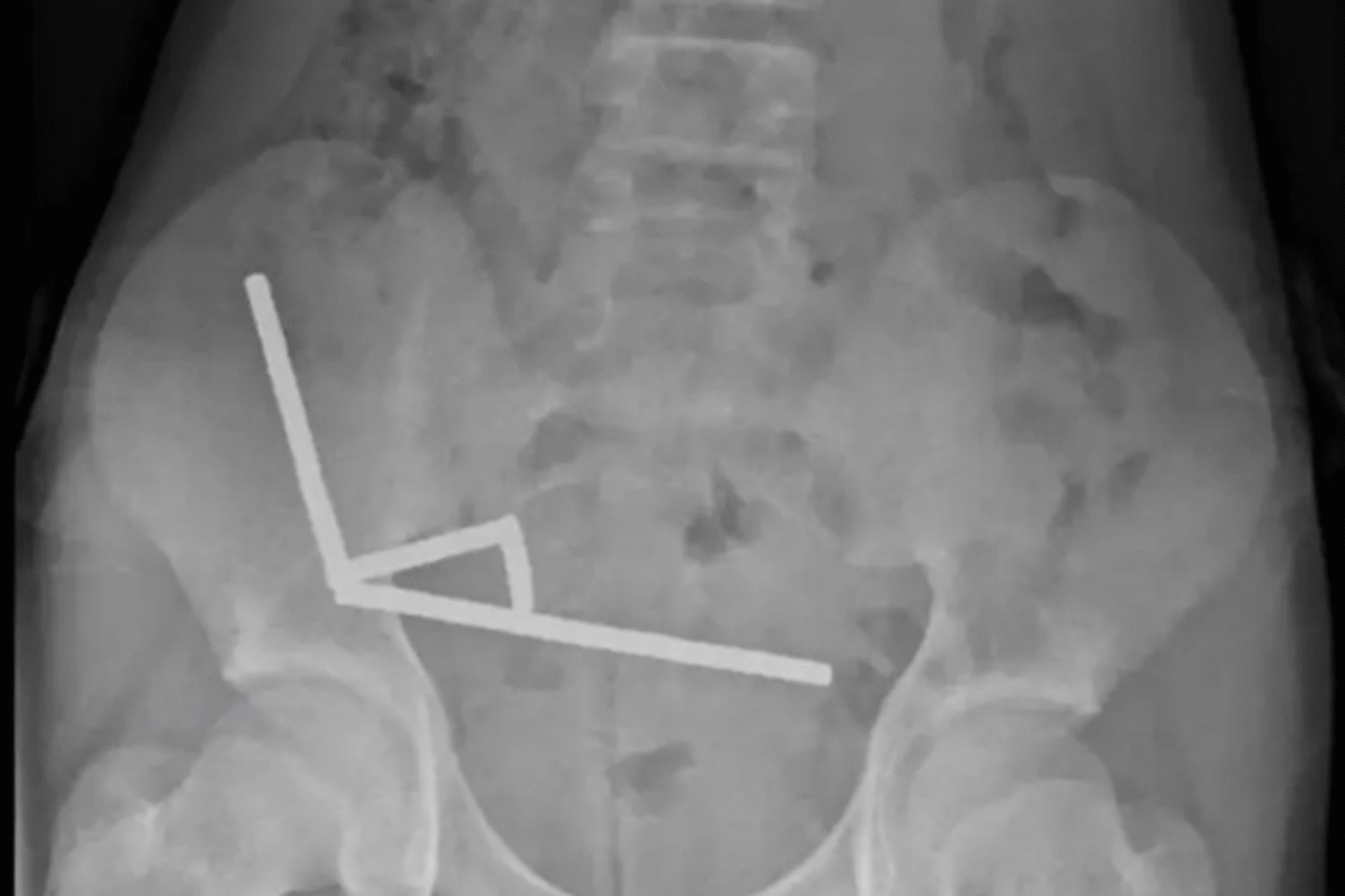 Menino engole quase 200 ímãs e sobrevive após cirurgia 1 Menino engole quase 200 ímãs e sobrevive após cirurgia