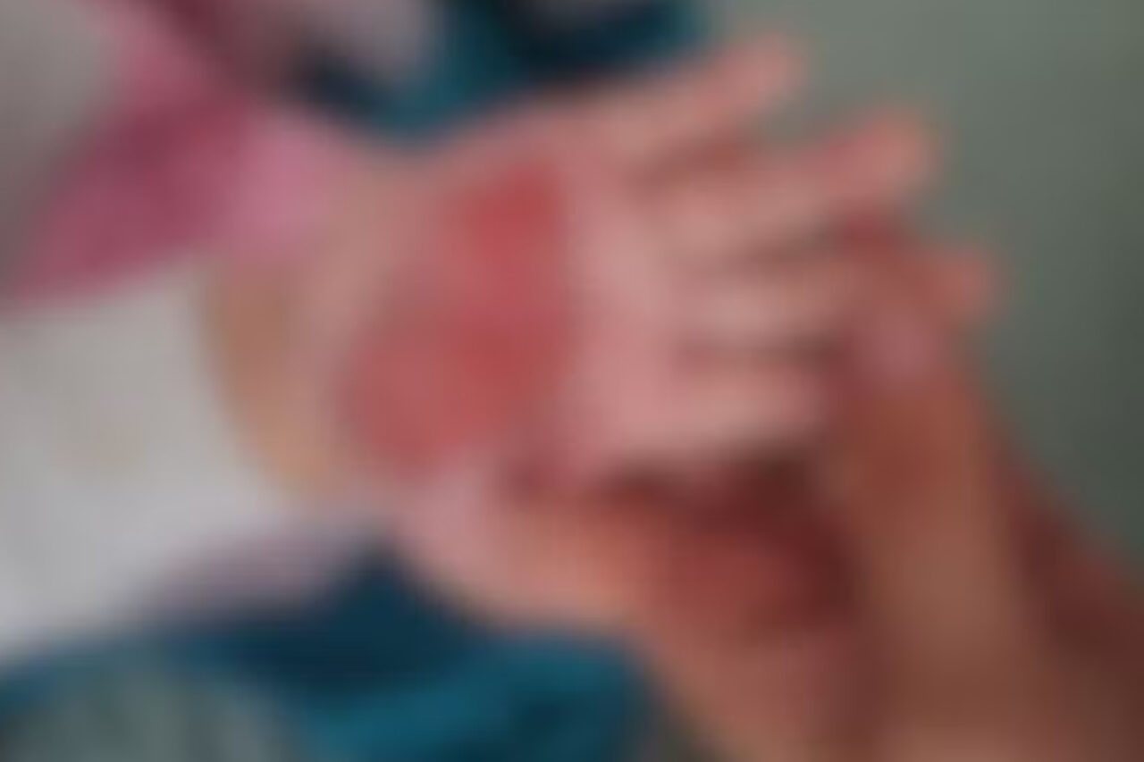 Madrasta queima mão de enteada de 2 anos com colher quente para 'castigá-la' em SC 3 De acordo com a PM, a madrasta se irritou com a menina enquanto ela brincava com outras duas crianças, em Itajaí. Polícia Civil abriu inquérito para investigar