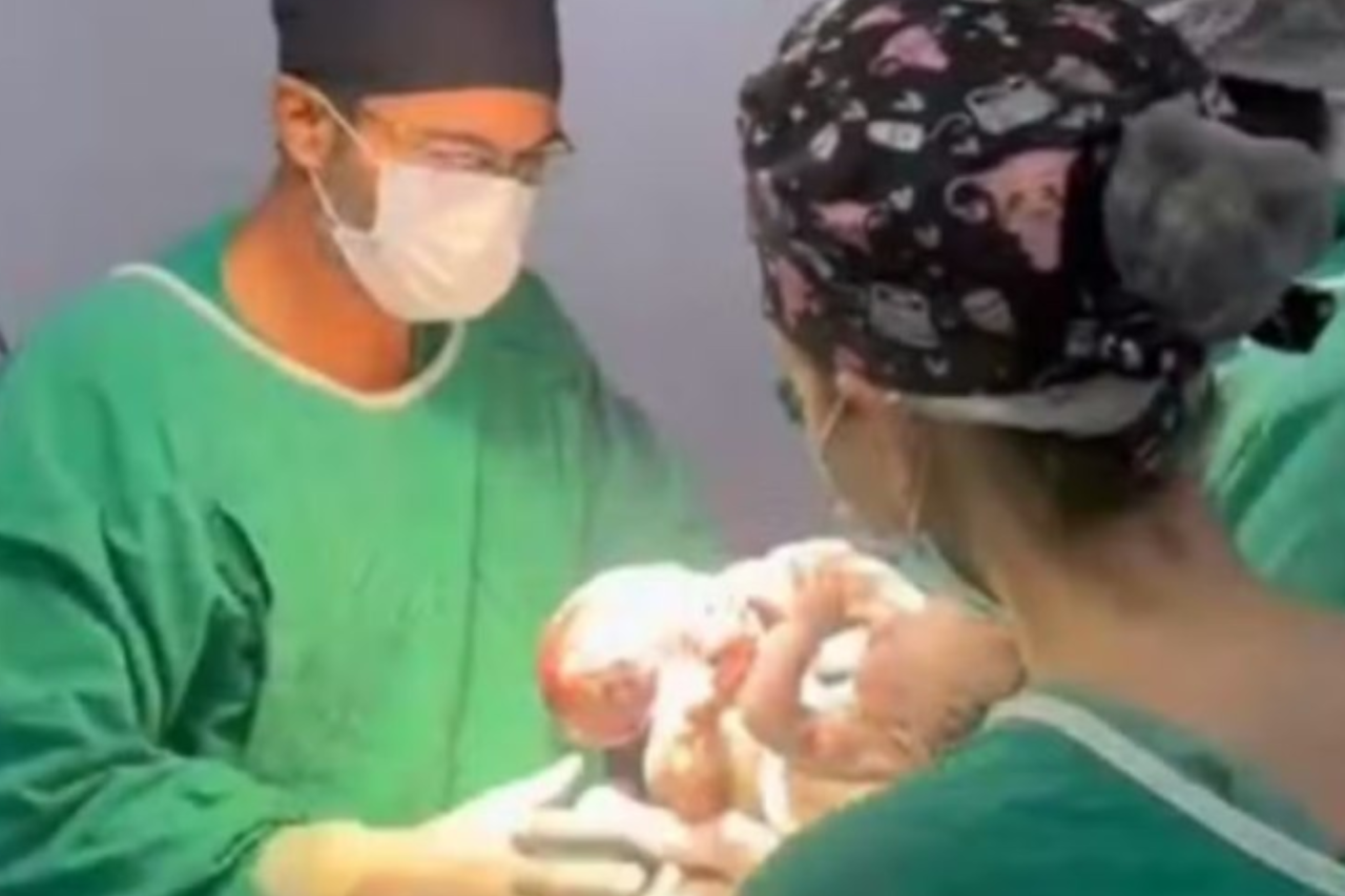 Os primeiros gêmeos siameses registrados no Brasil em 2026 nasceram em Goiânia, em parto de alta complexidade no Hospital Estadual da Mulher, e seguem internados na UTI sob acompanhamento especializado.