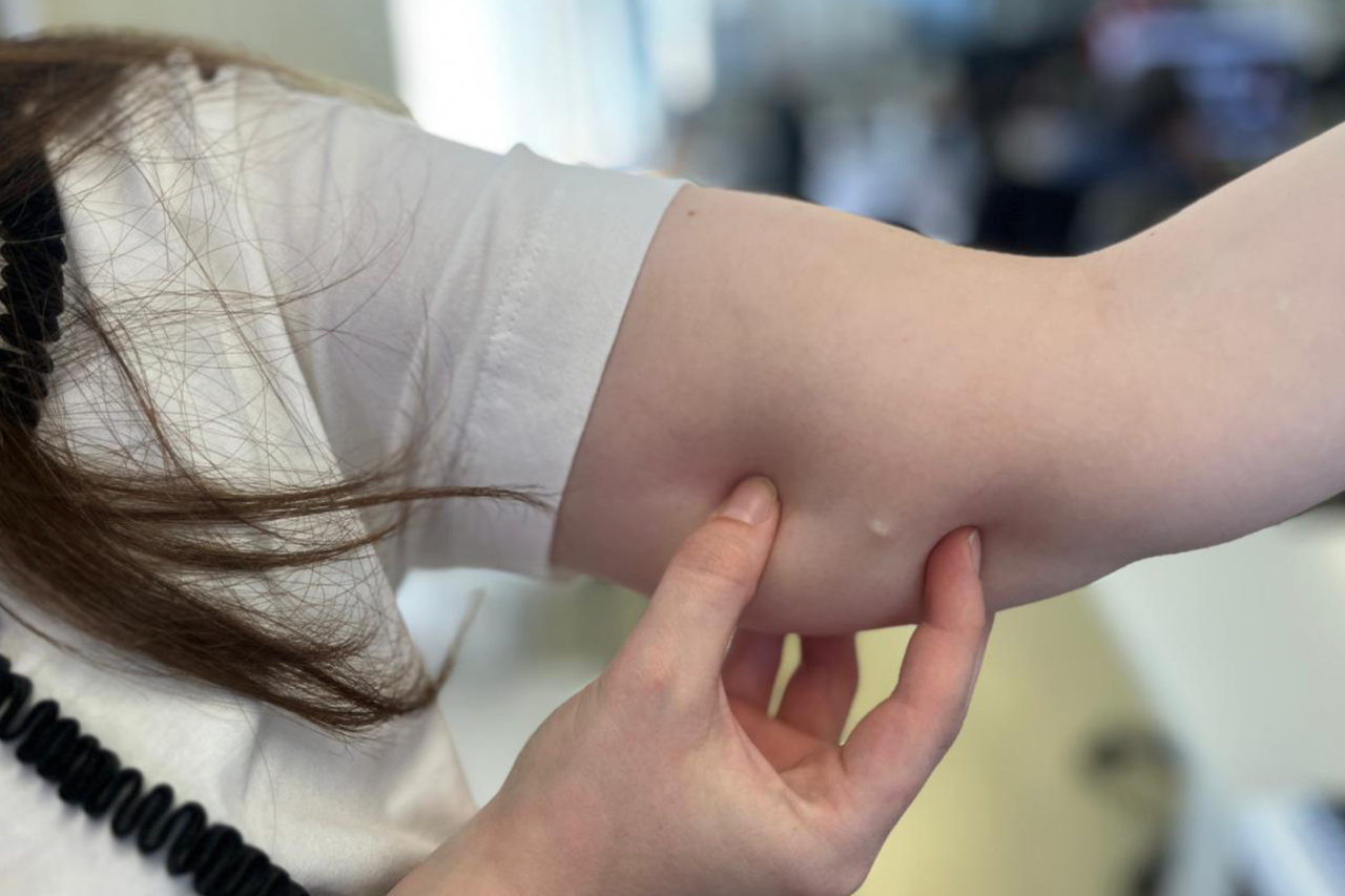 Paraná amplia acesso ao implante anticoncepcional e registra crescimento de 118% nos procedimentos em 2025 3 Paraná registrou aumento de 118% na inserção do implante anticoncepcional Implanon NXT entre 2024 e 2025, após ampliação de critérios e distribuição pelo SUS.