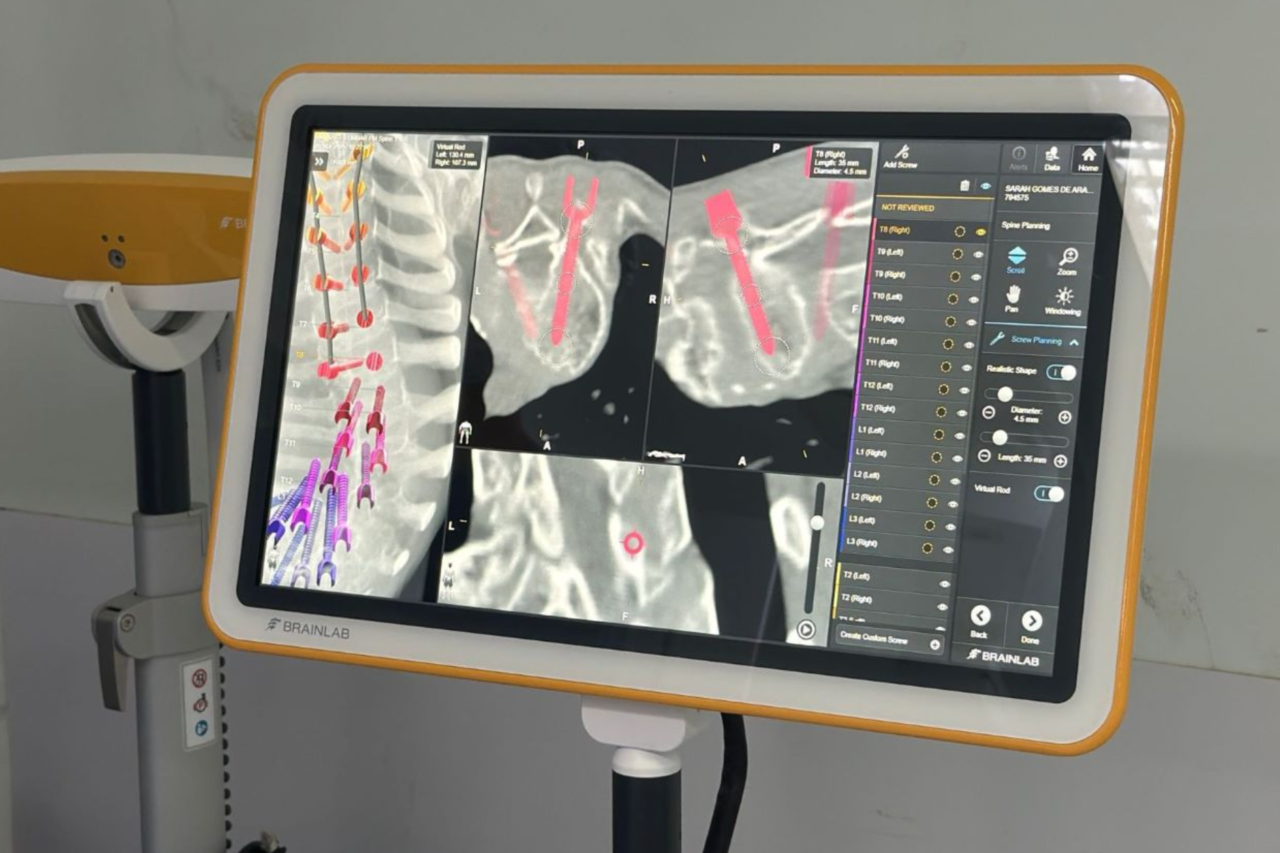 Hospital Infantil de Florianópolis realiza cirurgia com neuronavegação em criança com displasia esquelética rara 4 crys 71 1