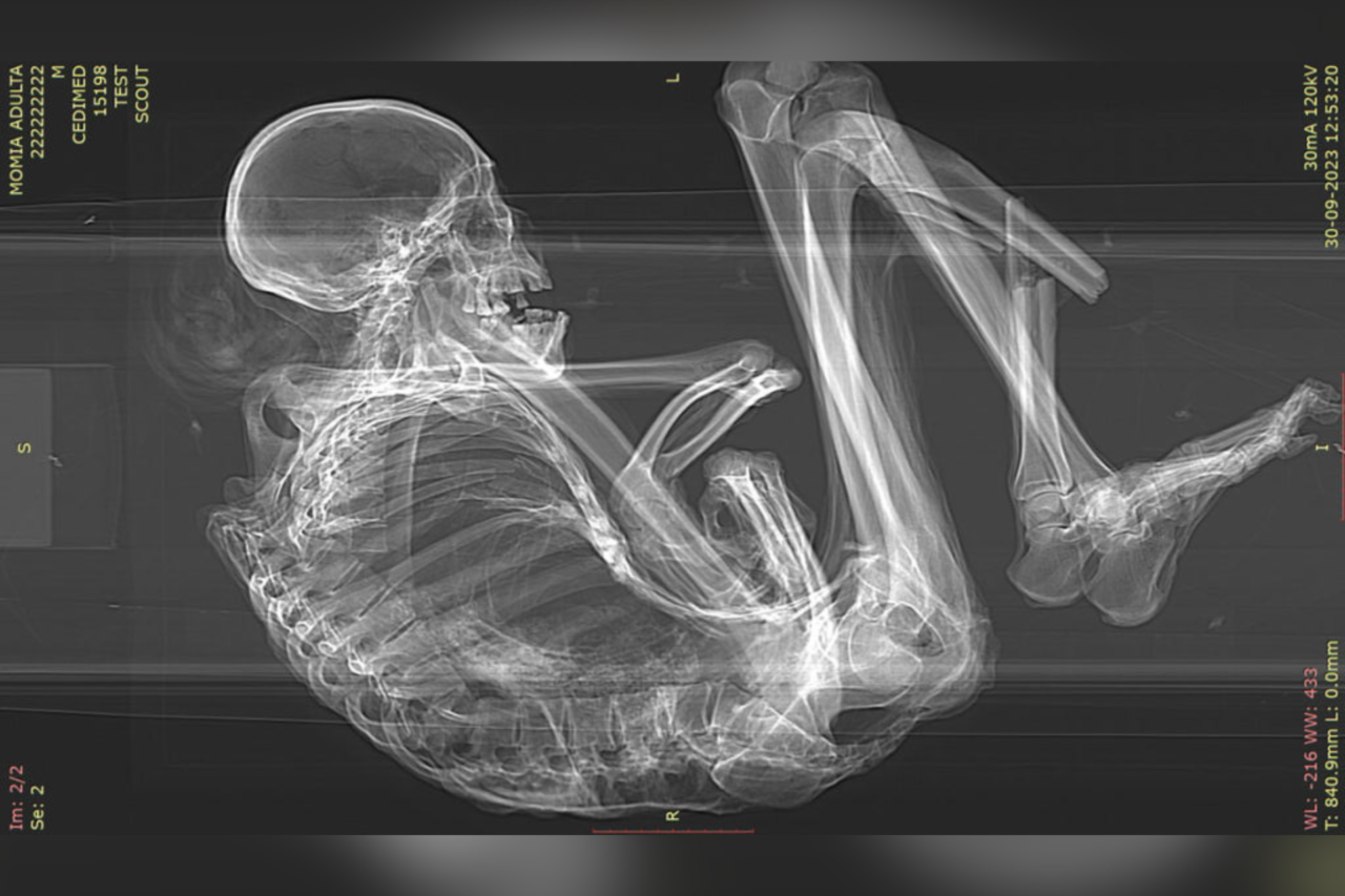 Estudo revela detalhes da morte de múmia de 1.100 anos encontrada no Deserto do Atacama 1 Estudo revela detalhes da morte de múmia de 1.100 anos encontrada no Deserto do Atacama