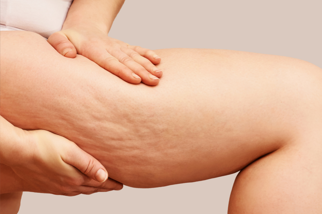 Celulite não depende só do açúcar: estresse crônico, salto alto e excesso de sal agravam o problema, alerta especialista 3 Celulite não depende só do açúcar: estresse crônico, salto alto e excesso de sal agravam o problema, alerta especialista