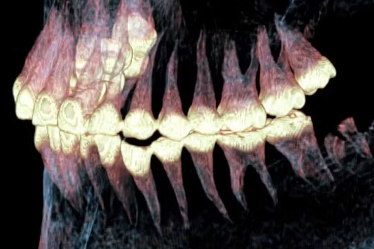 Múmia de 2.500 anos na Sibéria revela prótese mandibular e cirurgia rara da Idade do Ferro 3 Múmia de 2.500 anos na Sibéria revela prótese mandibular e cirurgia rara da Idade do Ferro
