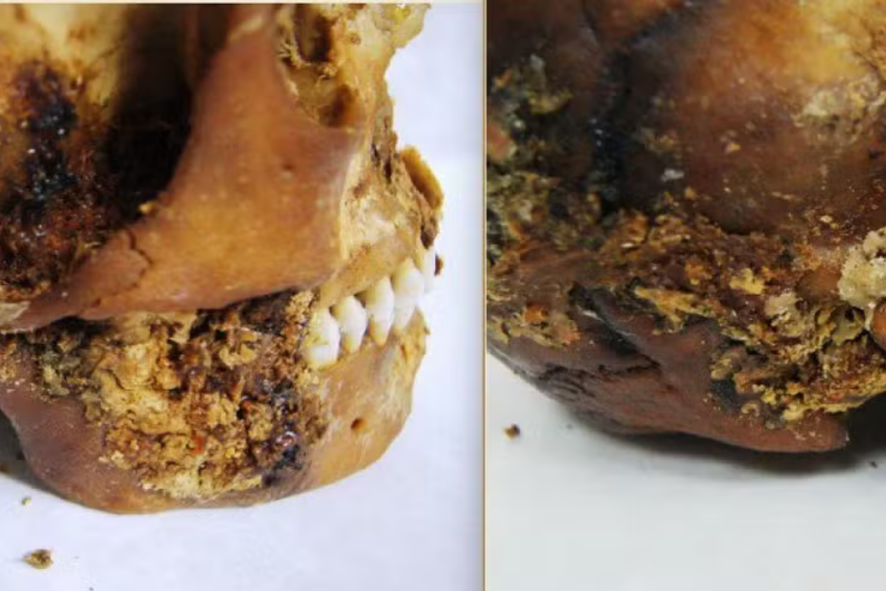 Múmia de 2.500 anos na Sibéria revela prótese mandibular e cirurgia rara da Idade do Ferro