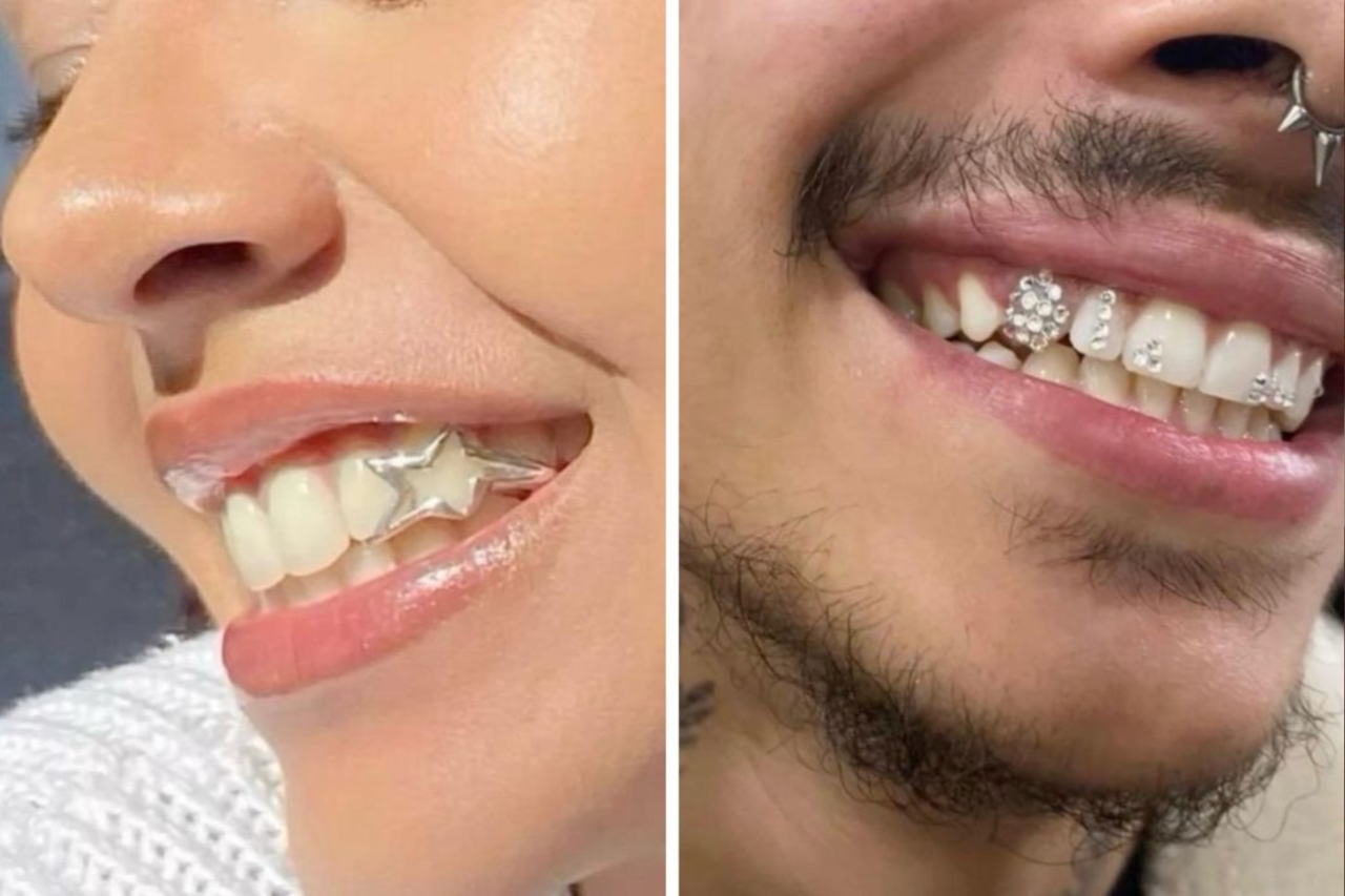 Joias nos dentes viram febre nos consultórios e prometem transformar o sorriso em acessório de moda 3 Joias nos dentes viram febre nos consultórios e prometem transformar o sorriso em acessório de moda