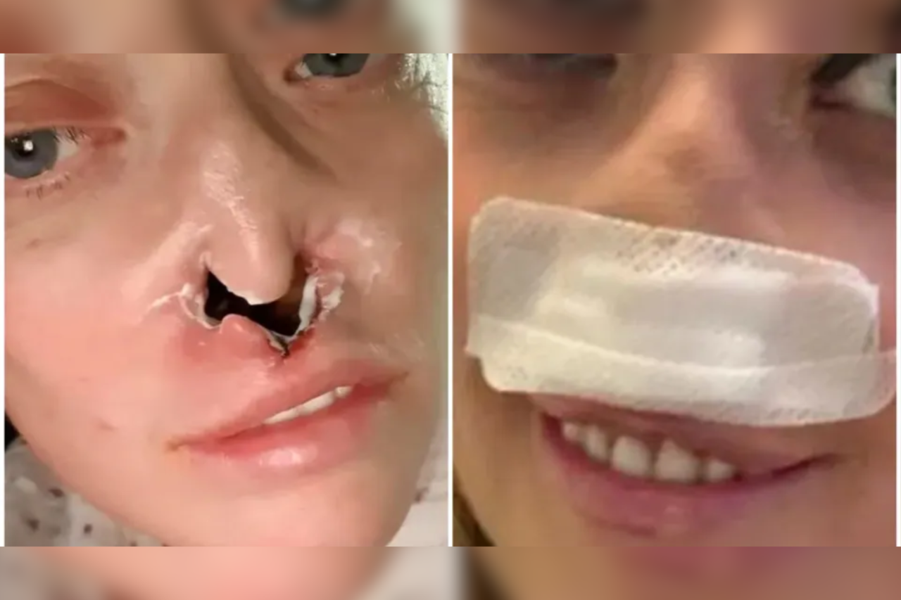 Britânica enfrenta complicações graves após implantes dentários realizados no exterior 30 Mulher de 41 anos relata complicações após procedimento dentário na Turquia; exames indicaram perfuração da cavidade nasal e possível infecção óssea.