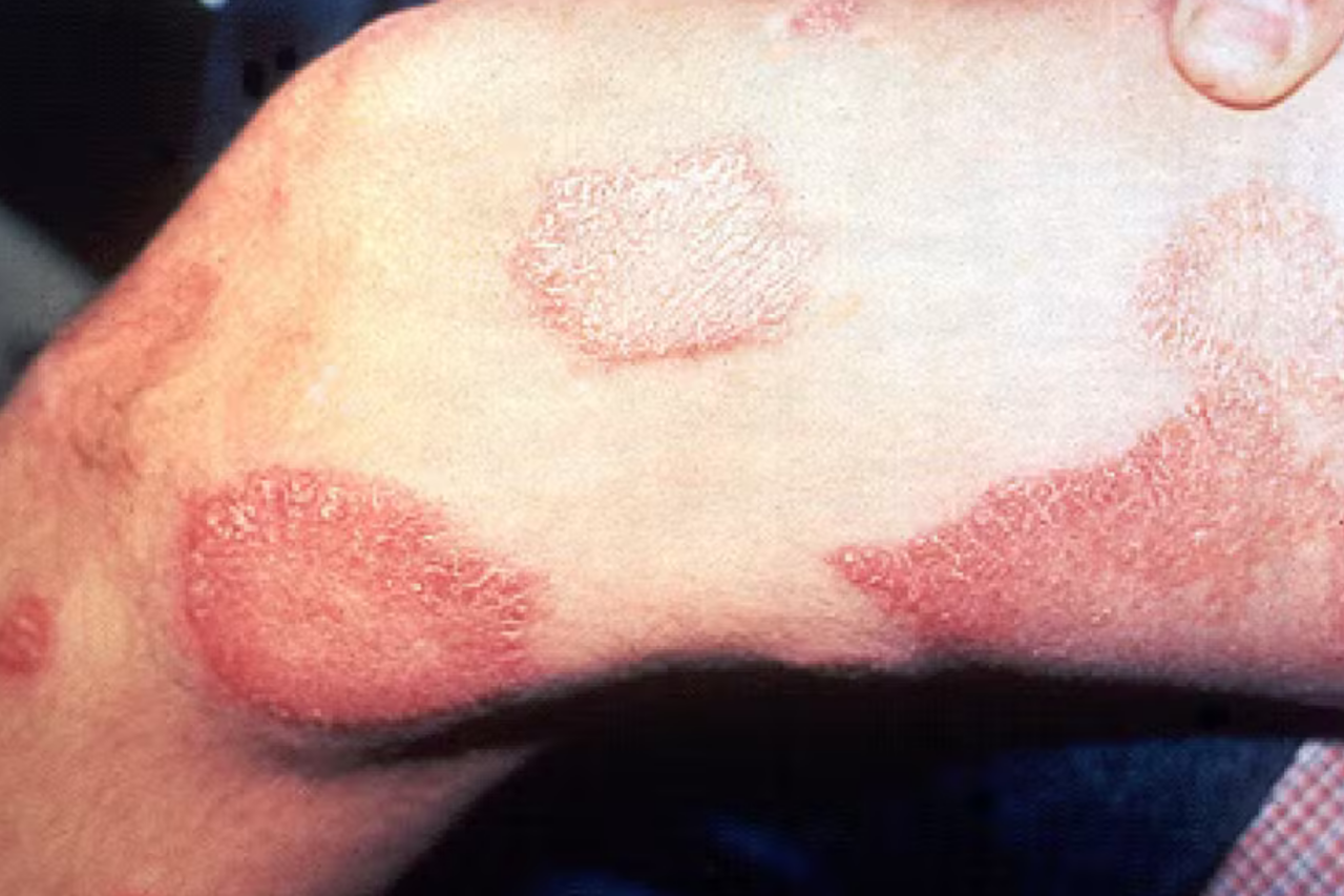 Chile é reconhecido pela OMS como primeiro país das Américas a eliminar a hanseníase 30 Chile é reconhecido pela OMS como primeiro país das Américas a eliminar a hanseníase