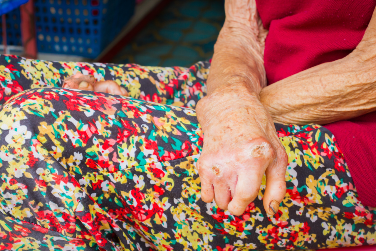 Chile é reconhecido pela OMS como primeiro país das Américas a eliminar a hanseníase 3 Chile é reconhecido pela OMS como primeiro país das Américas a eliminar a hanseníase