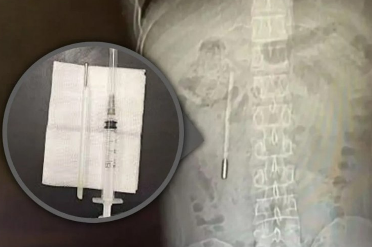 Homem descobre termômetro no intestino após 20 anos 1 Homem descobre termômetro no intestino após 20 anos