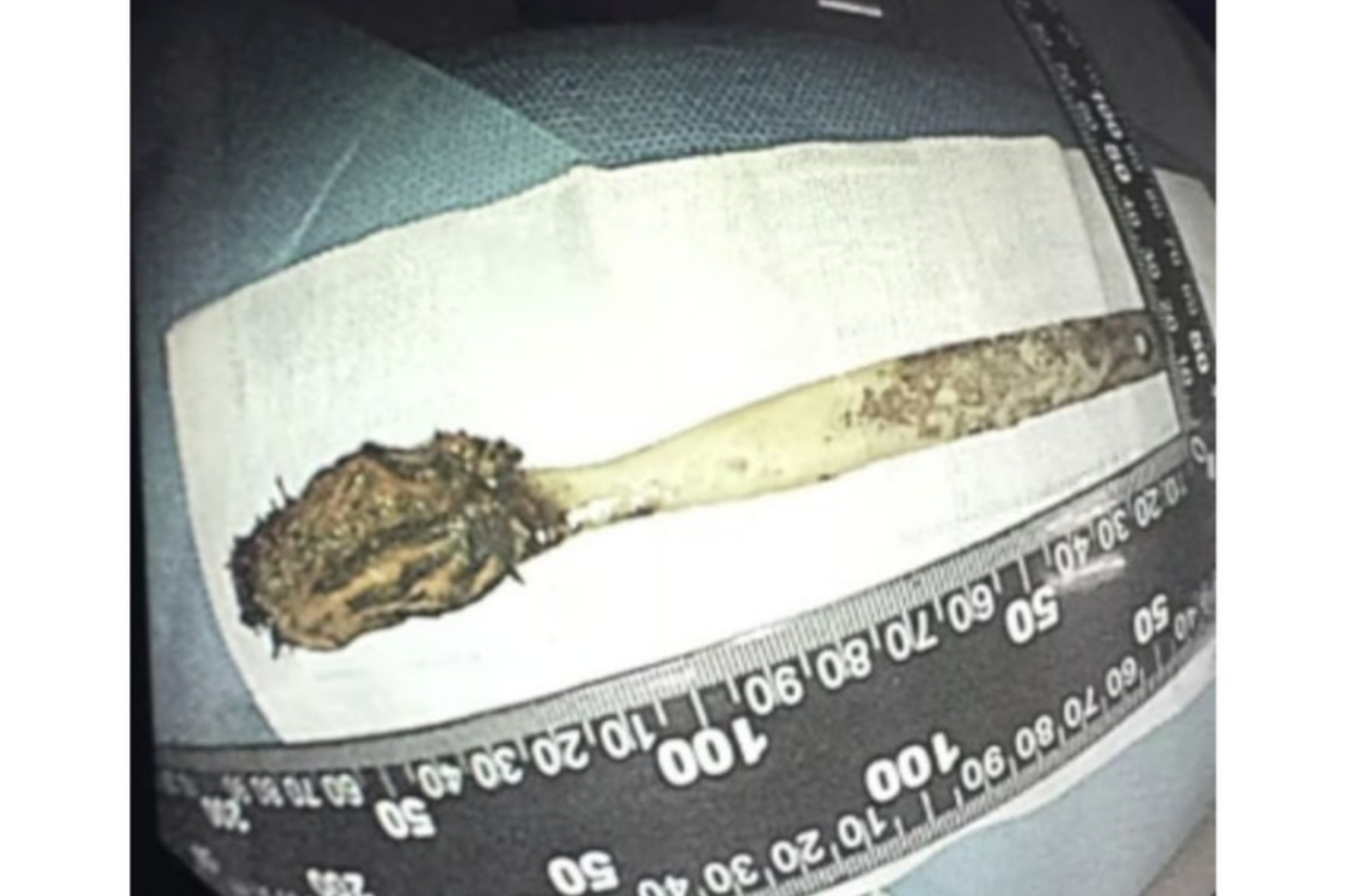 Homem descobre termômetro no intestino após 20 anos 3 Homem descobre termômetro no intestino após 20 anos