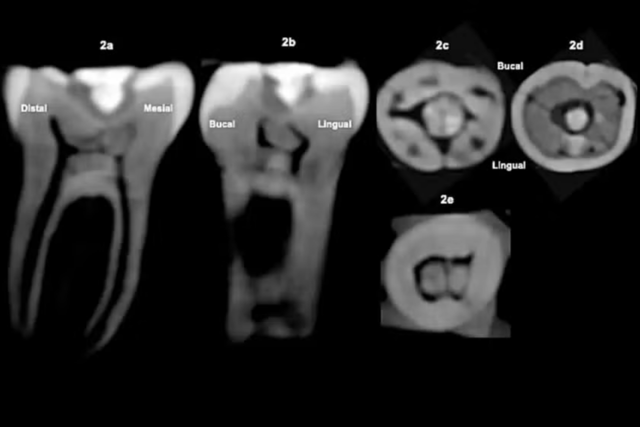 Dente maia com pedra preciosa intriga cientistas 3 Dente maia com pedra preciosa intriga cientistas