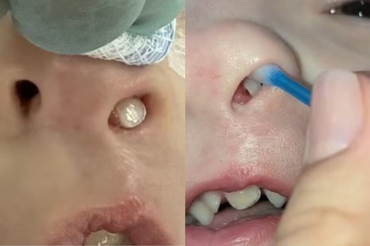 Dente nasce dentro do nariz de criança de 3 anos 4 Segundo a especialista, esse tipo de ocorrência é incomum. Criança precisou passar por cirurgia para retirar o dente