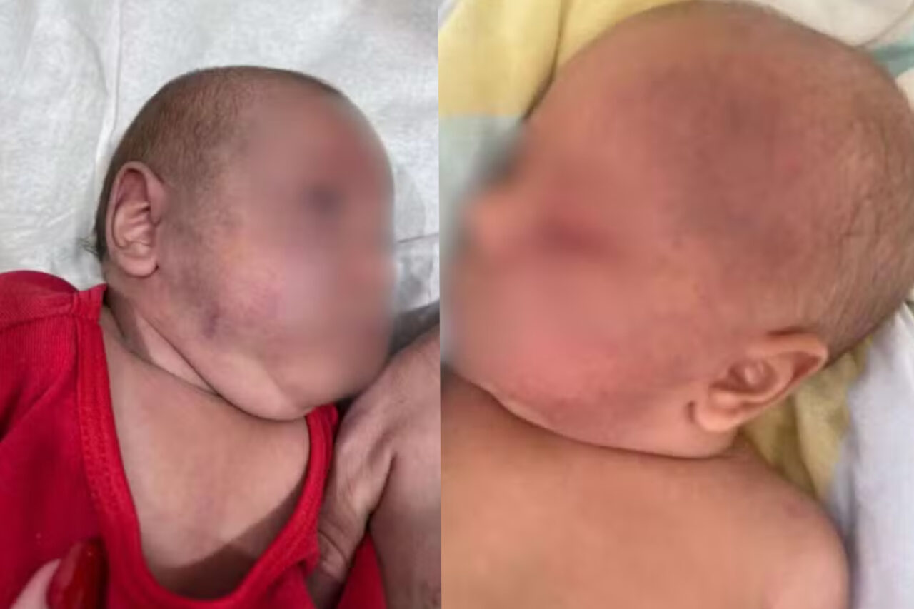 Pai que espancou bebê de 3 meses é condenado a mais de 22 anos de prisão 3 Criança sobreviveu após atendimento médico e ficou com sequelas permanentes. O pai foi condenado por tentar matar o próprio filho