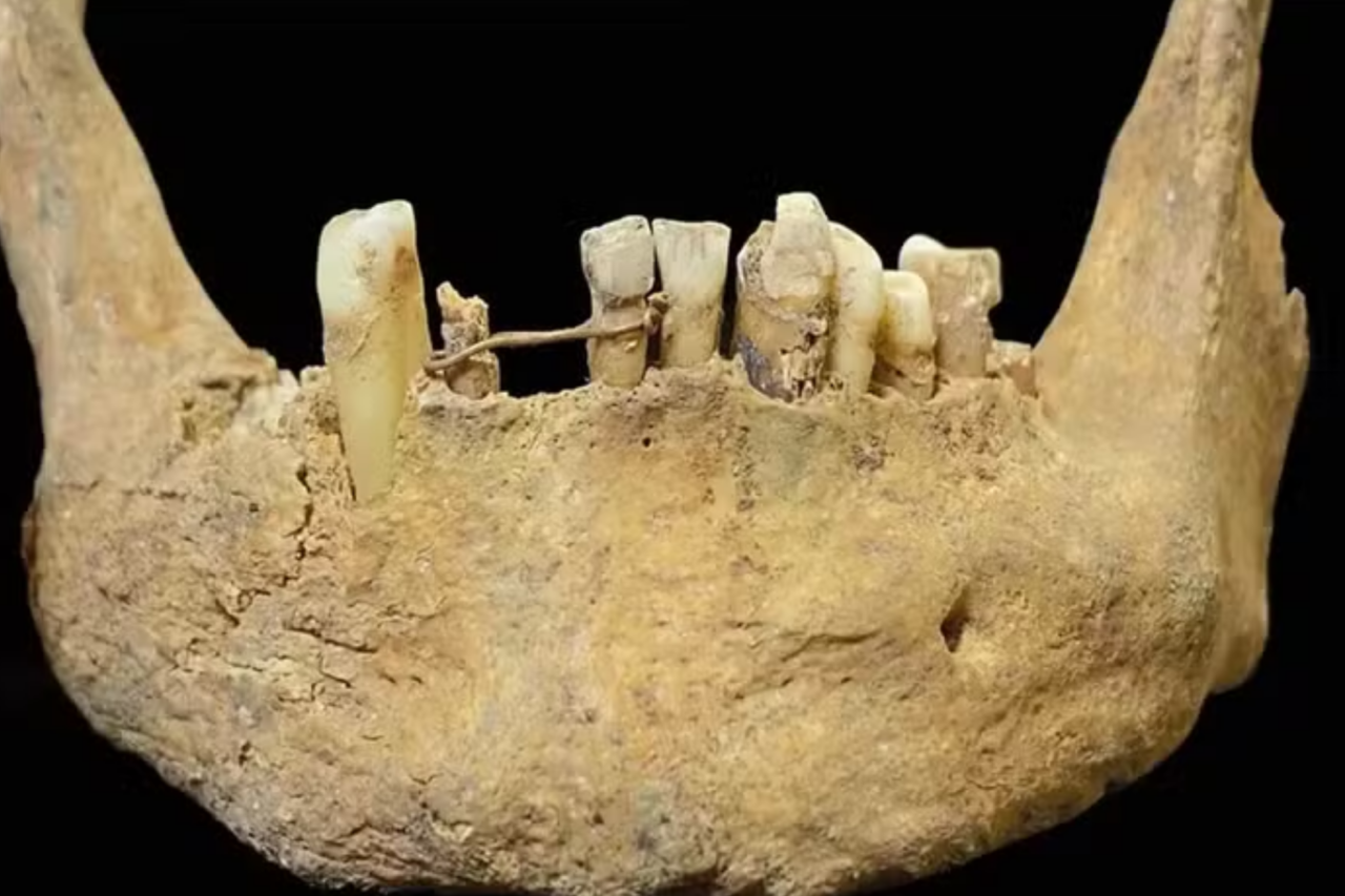 Mandíbula encontrada na Escócia revela tratamento dentário com ouro feito há 500 anos