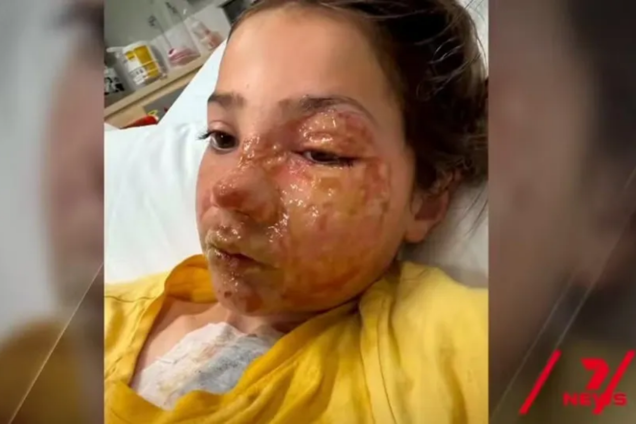Menina de 10 anos é hospitalizada após brinquedo aquecido explodir no rosto
