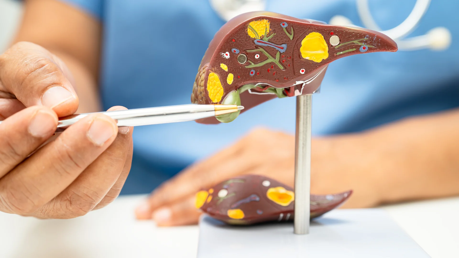 Estudo alerta que gordura no fígado atinge 20% dos brasileiros e pode evoluir para câncer sem sintomas aparentes, reforçando a importância do diagnóstico precoce