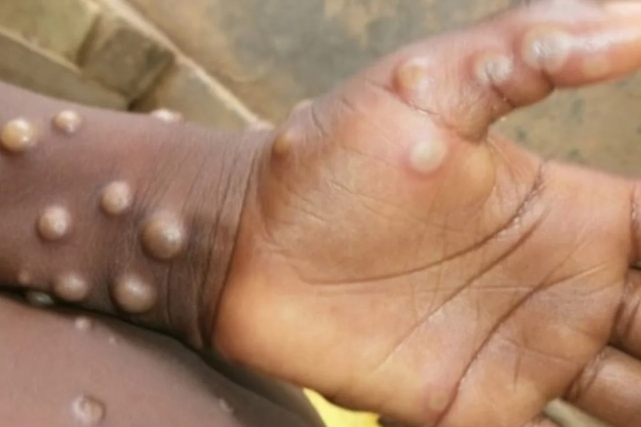 Porto Alegre confirma novo caso de Mpox e reforça orientações de prevenção 14 Prefeitura de Porto Alegre confirma caso de Mpox contraído fora do Estado e divulga orientações de prevenção para o Carnaval, incluindo higiene das mãos e atenção a sintomas.