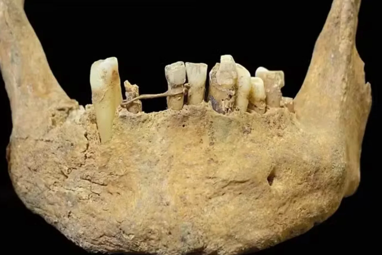 Mandíbula encontrada na Escócia revela tratamento dentário com ouro feito há 500 anos